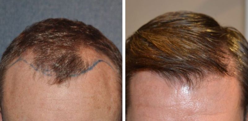 Wimpole patient before and after FUT hair transplant