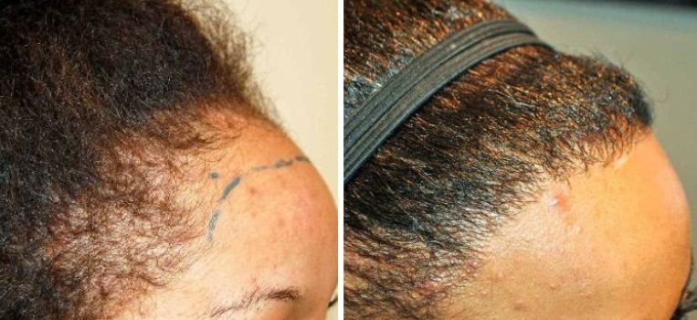 Destiny before and after female hair transplant at the Wimpole Clinic