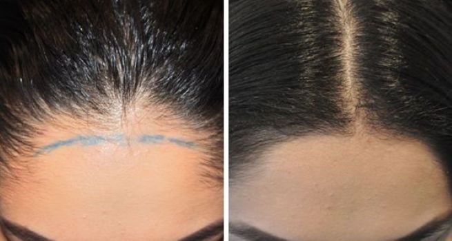 Can Women Have Hair Transplants?, Wimpole Clinic