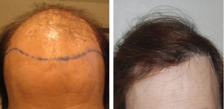 Jessica before and after female hair transplant at the Wimpole Clinic