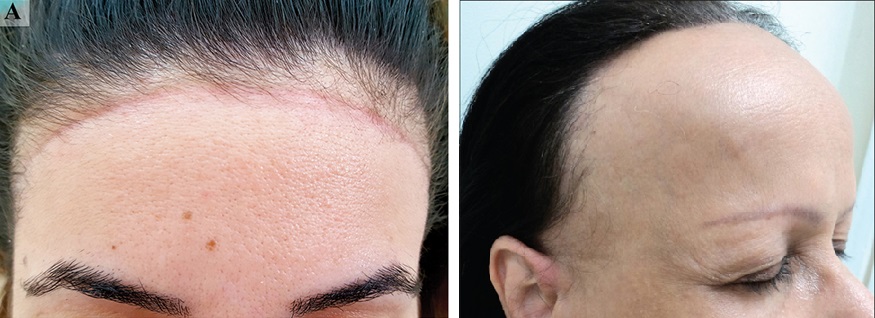Examples of women with a receding hairline