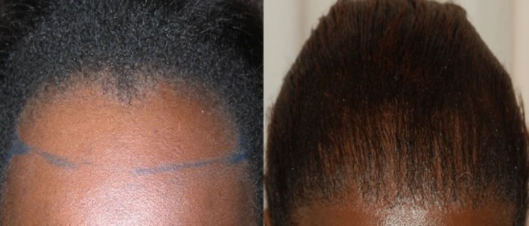 Female Wimpole patient before and after afro hair transplant