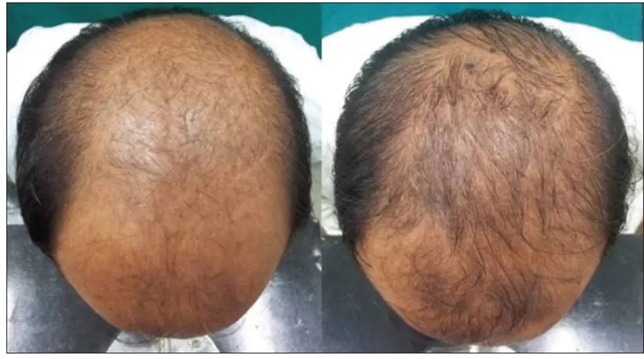 Hair of a patient before and after 6 months of daily 1mg Finasteride use