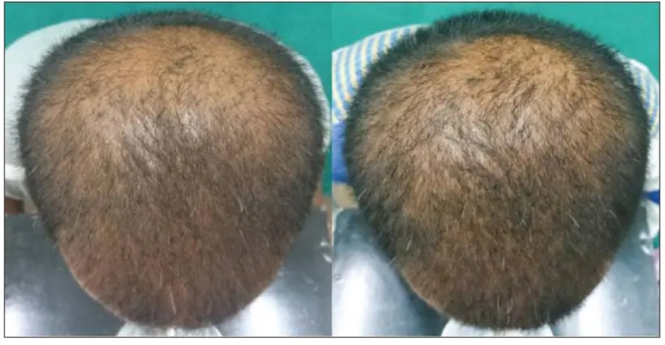 Hair of a patient before and after 6 months of daily 1mg Finasteride use.