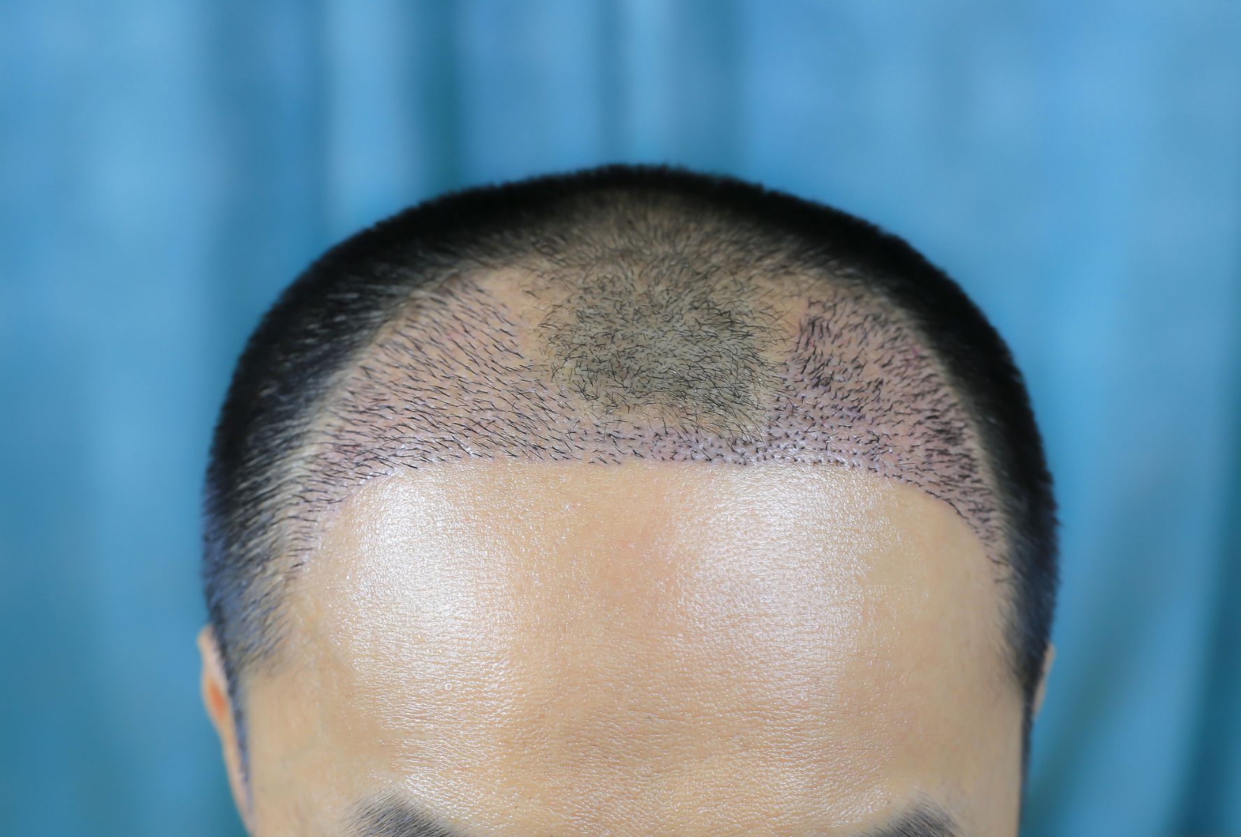 Hairline transplant for uneven hairline