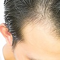 Finasteride Shedding: What Is It And Why Does It Happen?