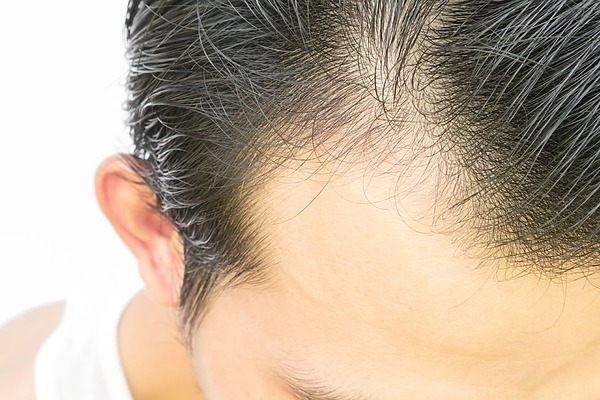 Man Affected By Finasteride Shedding