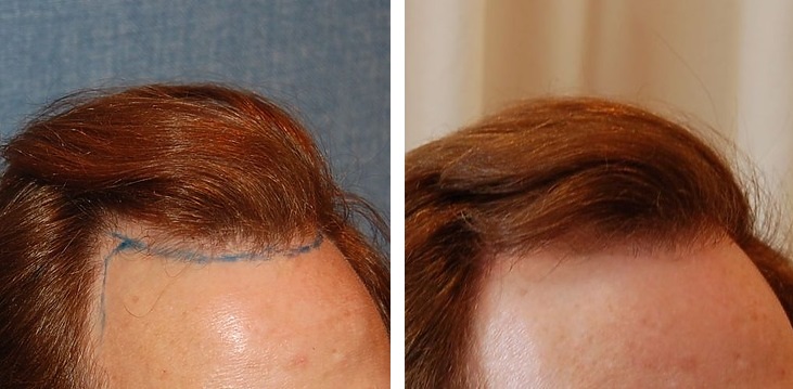 Men before and after hair transplant