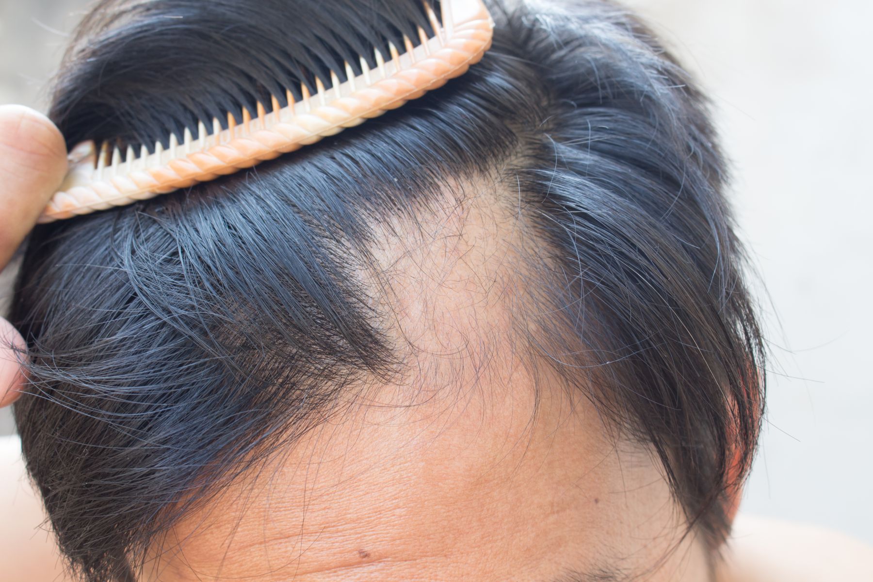 Uneven hairline as a sign of balding