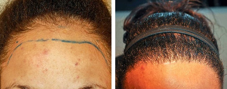 Wimpole patient before and after female hair transplant
