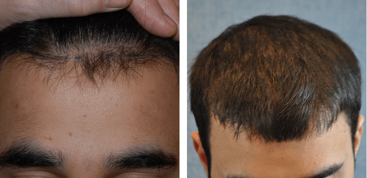 Wimpole patient before and after hair transplant for a receding hairline
