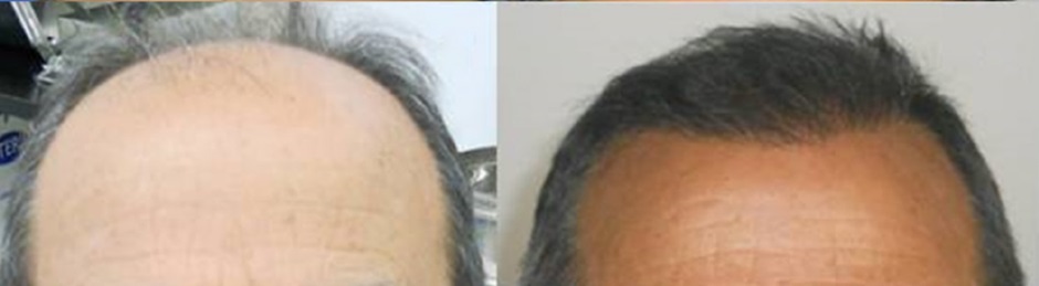 DHI hair transplant for Norwood stage 4