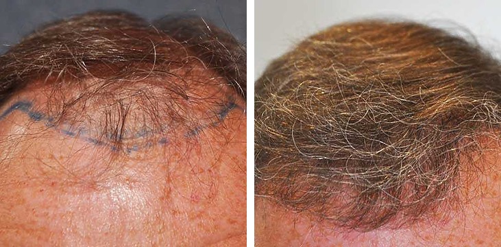 1600 grafts FUE hair transplant UK