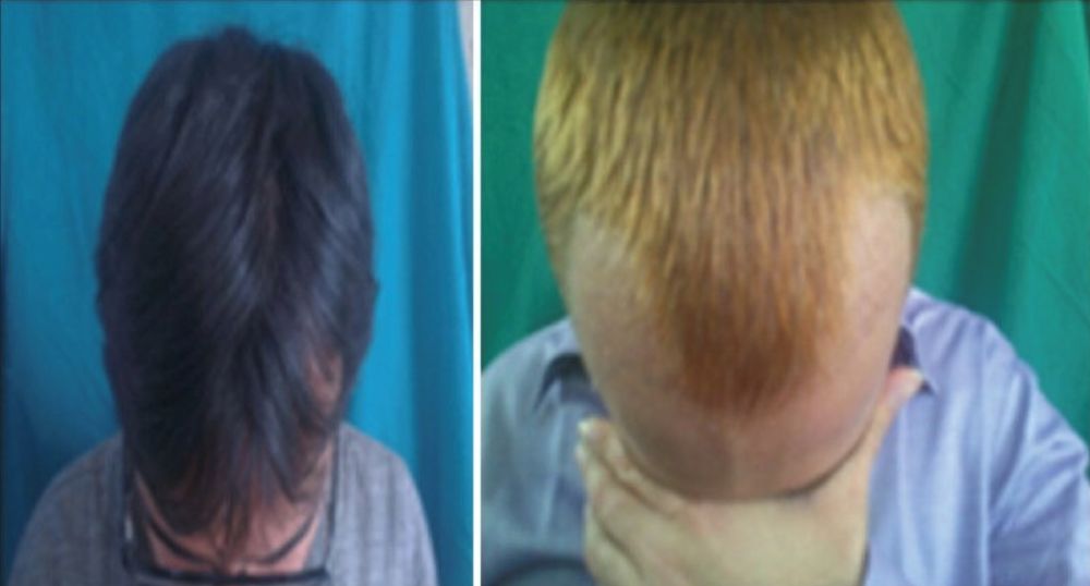 Hair bleaching due to excessive hydrogen peroxide usage to remove crusts