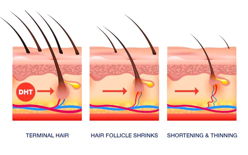 How DHT affects sensitive hair follicles