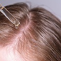 Can You Use Stemoxydine For Hair Loss