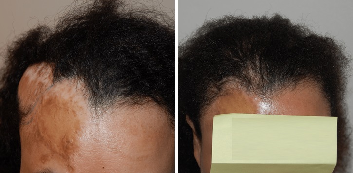 FUE hair transplant into scar tissue