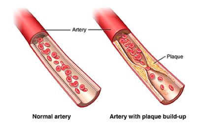 artery with plaque build up