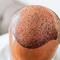 How To Deal With Hair Transplant Scabs