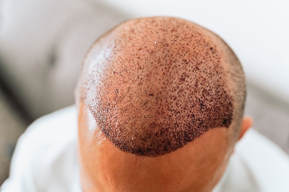 Hair Transplant Scabs: What’s Normal and What’s Not