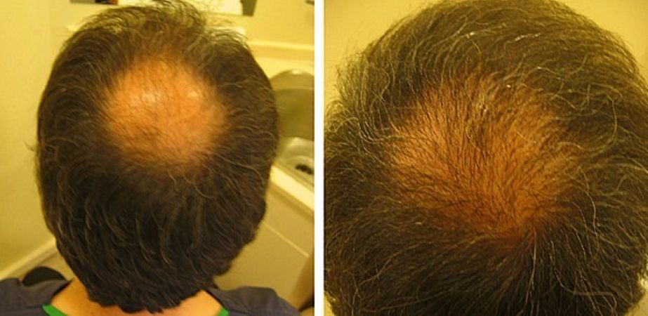 Before crown hair transplant and 5 months after surgery (FUE, 1800 grafts)
