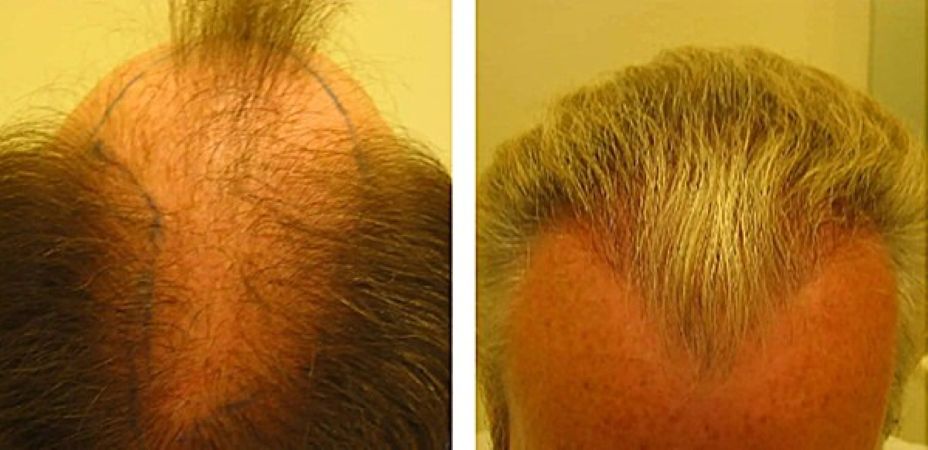 Before hair transplant and 11 months after surgery (FUE, 2700 grafts)