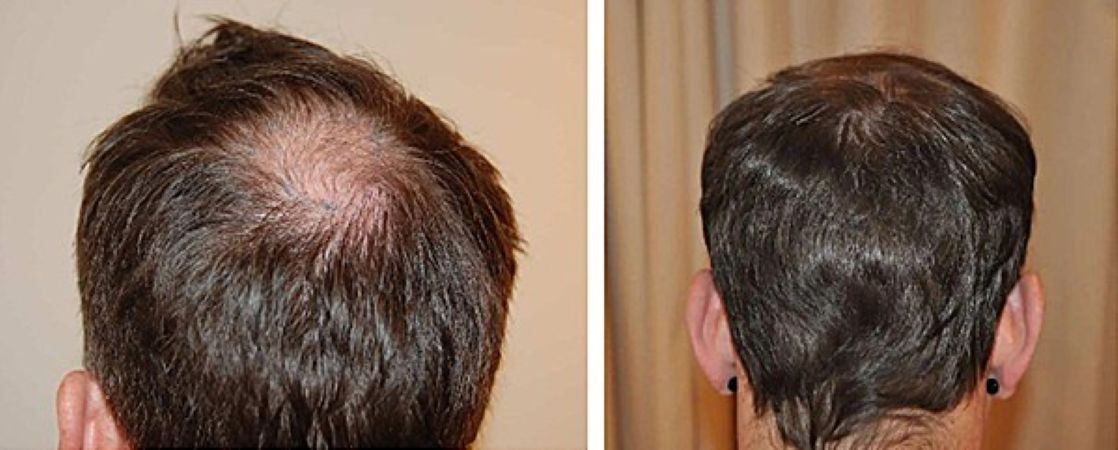 Before hair transplant and 12 months after surgery (FUE, 800 grafts)