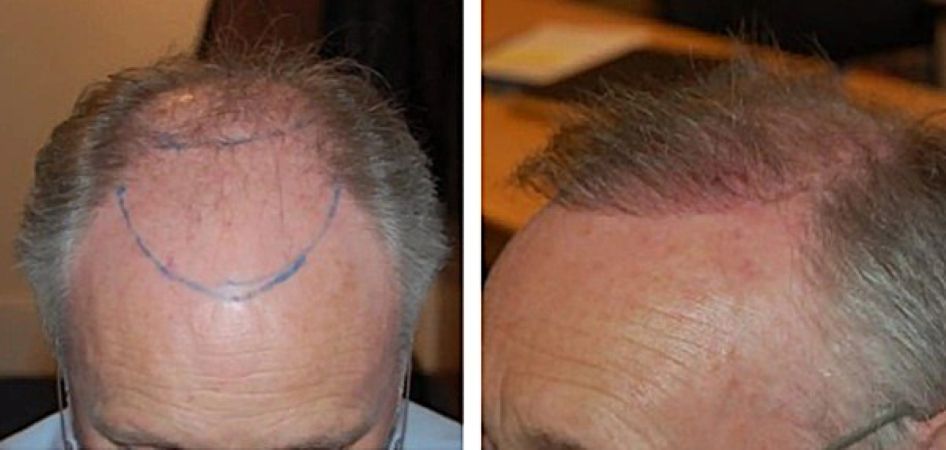 Before hair transplant and 3 months after surgery (FUE, 2300 grafts)
