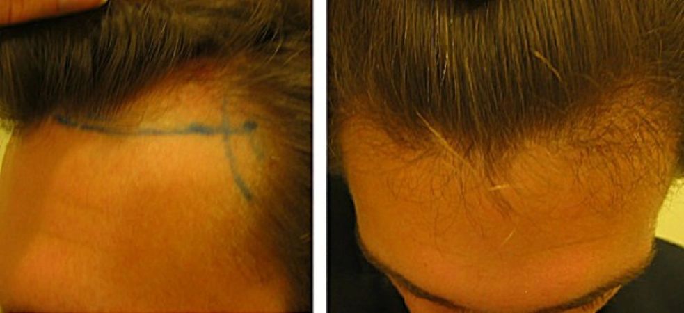 Before hair transplant and 4 months after surgery (FUE, 750 grafts)