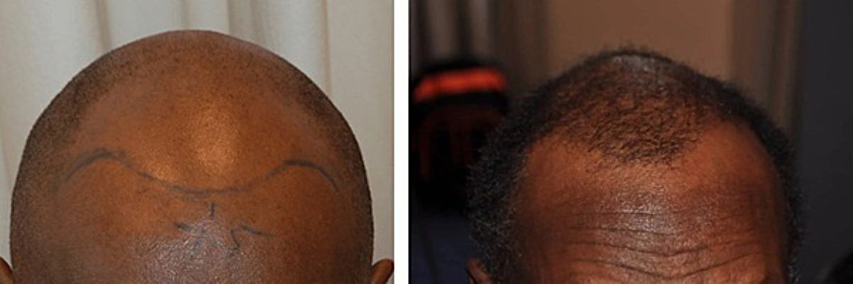 Before hair transplant and 6 months after surgery (FUE, 2200 grafts)