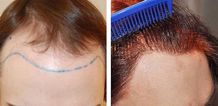 Before hair transplant and 9 months after surgery (FUE, 1800 grafts)