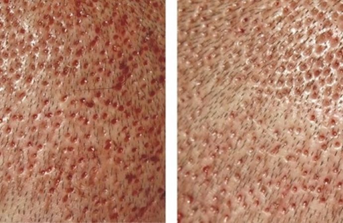 Close-up photos of scalp skin 1 day after an FUE hair transplant