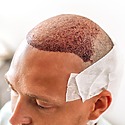 Hair Transplant Infection: Everything You Need To Know