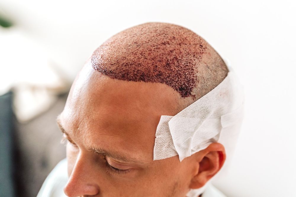 Hair Transplant Infection: Everything You Need To Know
