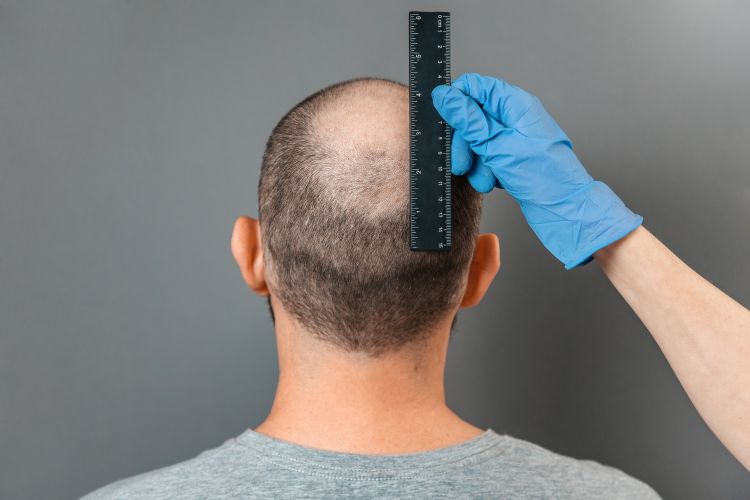 How is male pattern baldness diagnosed?