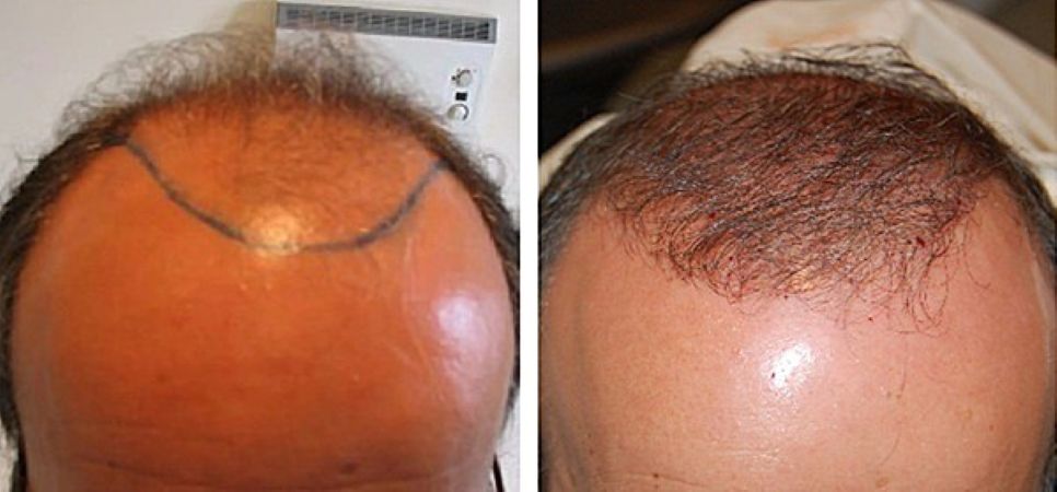 Pre-hair transplant and 3 months after surgery (FUE, 2200 grafts)