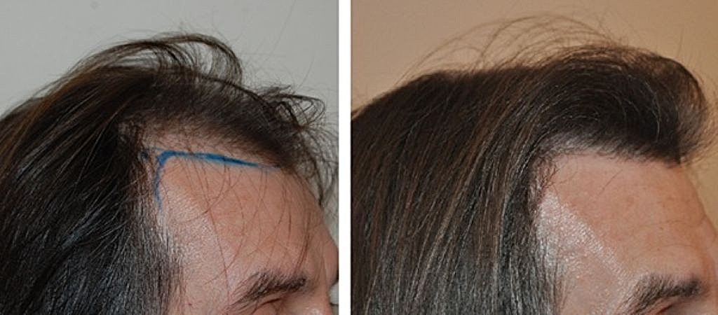 Temple before and after hair transplant