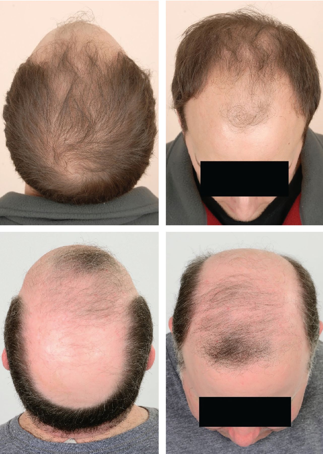 Male Pattern Baldness: Causes, Stages &#038; Treatment Options, Wimpole Clinic