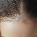 Female Pattern Baldness: Causes, Stages & Treatment Options