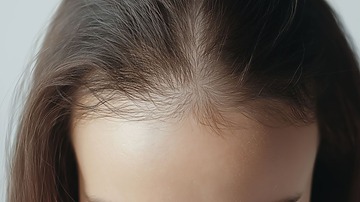 female pattern baldness