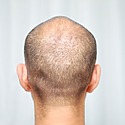 What Is Hair Transplant Overharvesting?