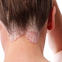 Does Seborrheic Dermatitis Cause Hair Loss?