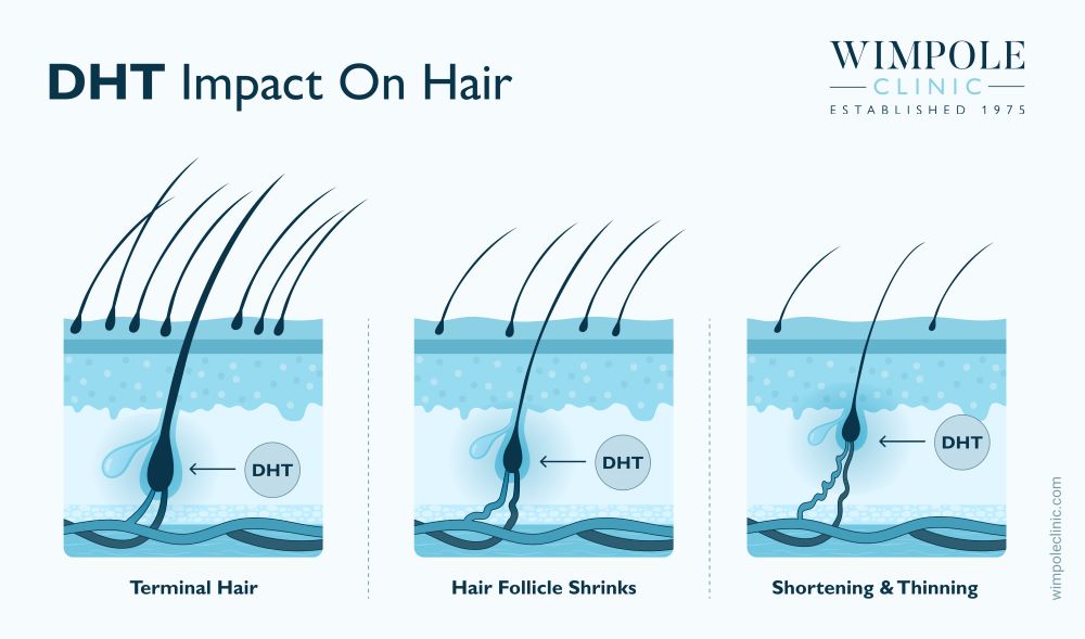 DHT Impact On Hair