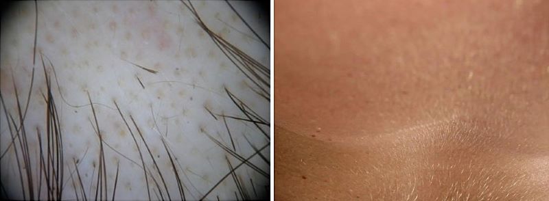 Exclamation hairs (left) and vellus hairs (right)