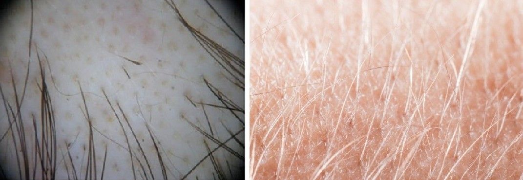 Exclamation hairs (left) and vellus hairs (right)