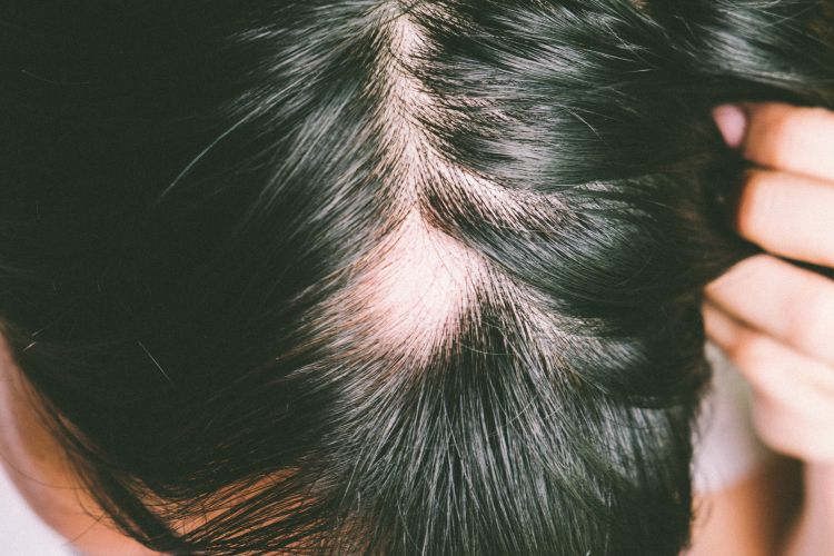 Patchy area of baldness caused by alopecia areata