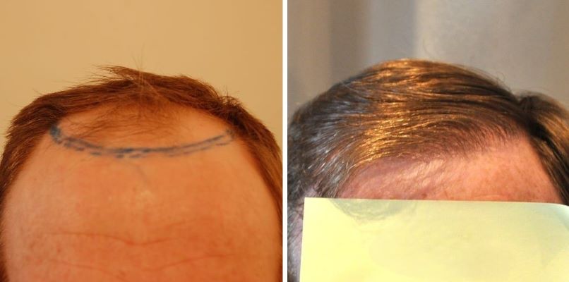 Patient’s hairline before and 3 years after 1500 graft FUT hair transplant