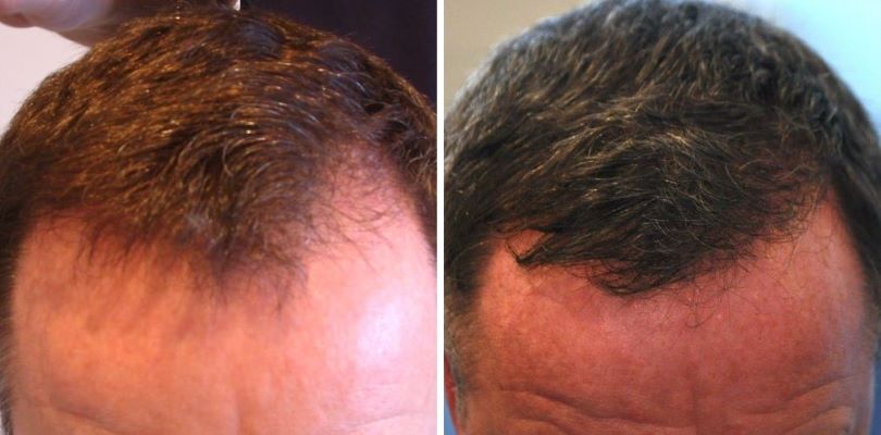 Patient’s hairline before and 6 years after 900 graft FUT hair transplant