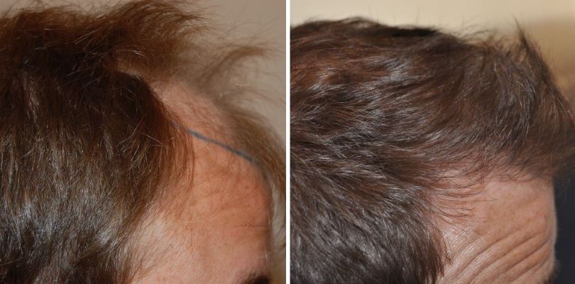 Patient’s temple before and 6 years after 1000 graft FUT hair transplant