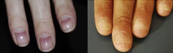 Red nails (left) and split nails (right) both caused by Alopecia Areata